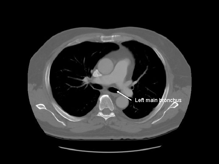 Left main bronchus 