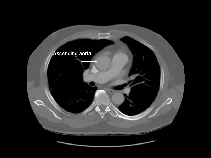 Ascending aorta 