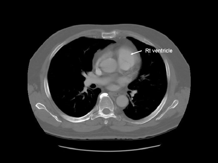 Rt ventricle 