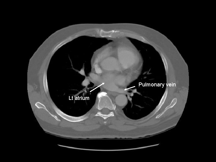 Pulmonary vein Lt atrium 