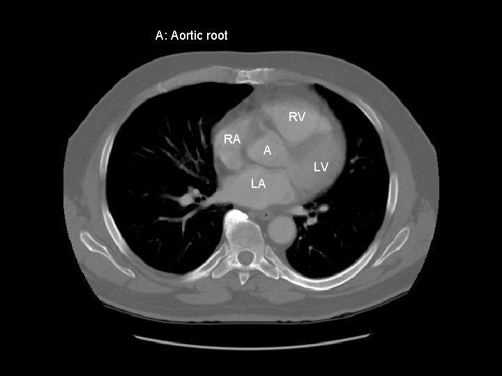 A: Aortic root RV RA A LV LA 