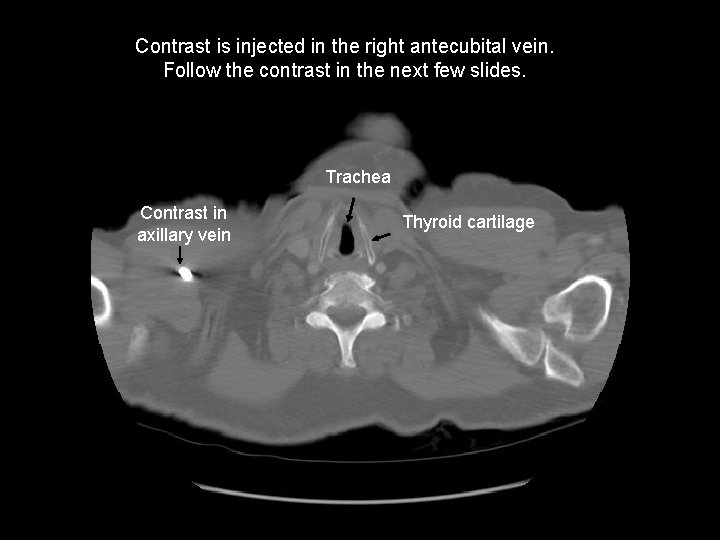 At the level of Contrast is injected in the right antecubital vein. Follow the