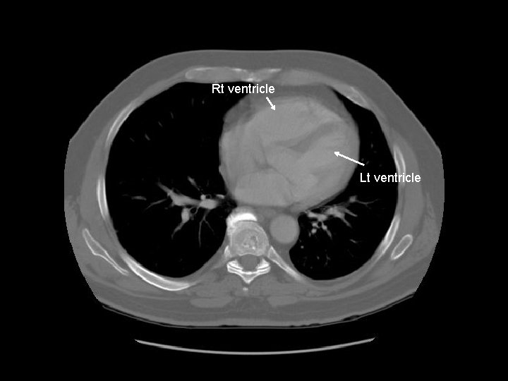 Rt ventricle Lt ventricle 