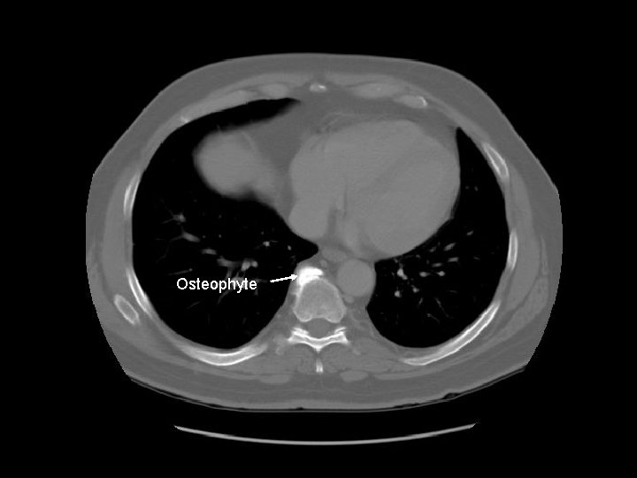 Osteophyte 