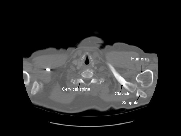 Humerus Cervical spine Clavicle Scapula 