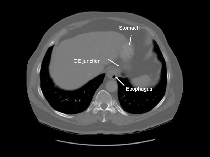 Stomach GE junction Esophagus 