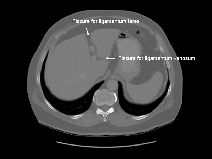Fissure for ligamentum teres Fissure for ligamentum venosum 