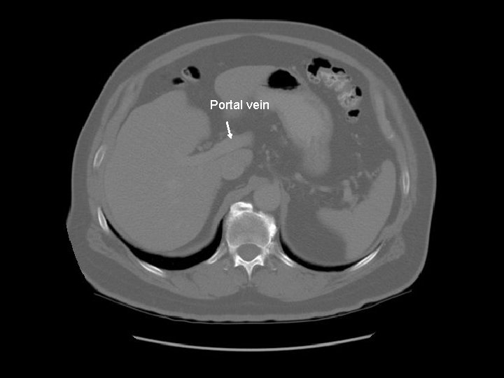 Portal vein 