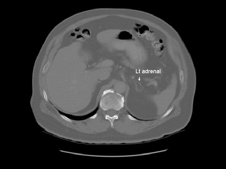 Lt adrenal 