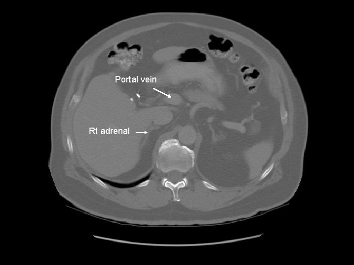 Portal vein Rt adrenal 