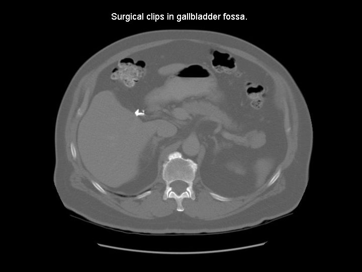 Surgical clips in gallbladder fossa. 