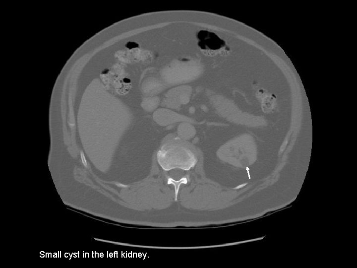 Small cyst in the left kidney. 