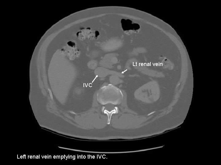 Lt renal vein IVC Left renal vein emptying into the IVC. 