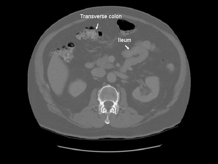 Transverse colon Ileum 