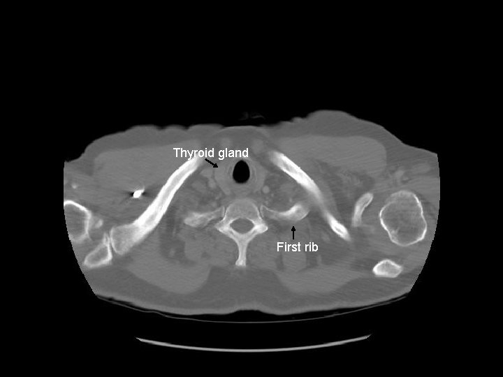 Thyroid Gland Thyroid gland First rib 