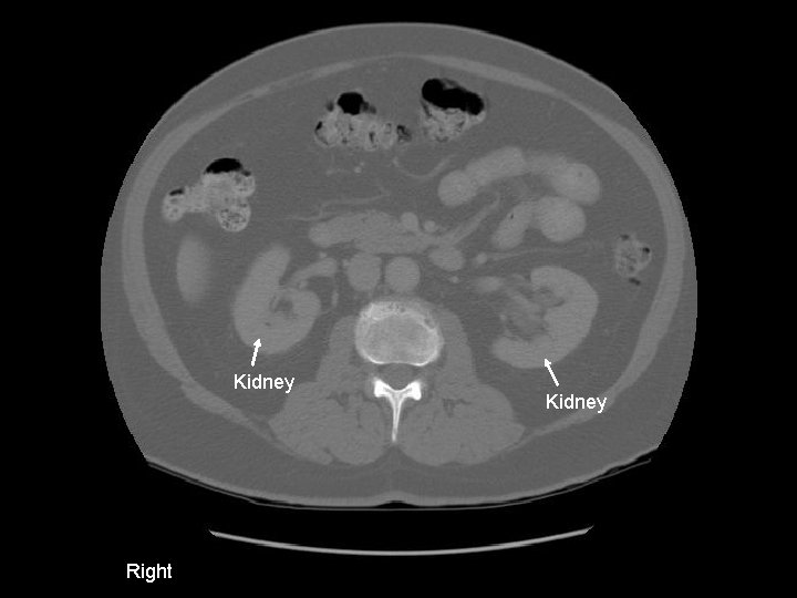 Kidney Right Kidney 