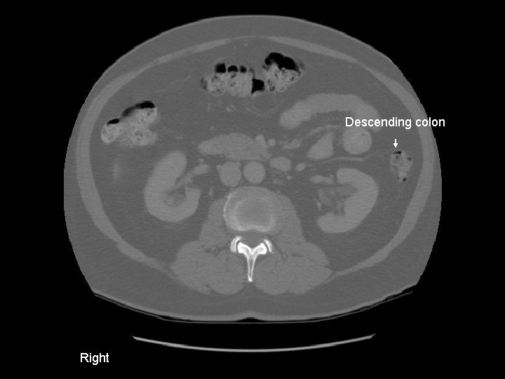 Descending colon Right 