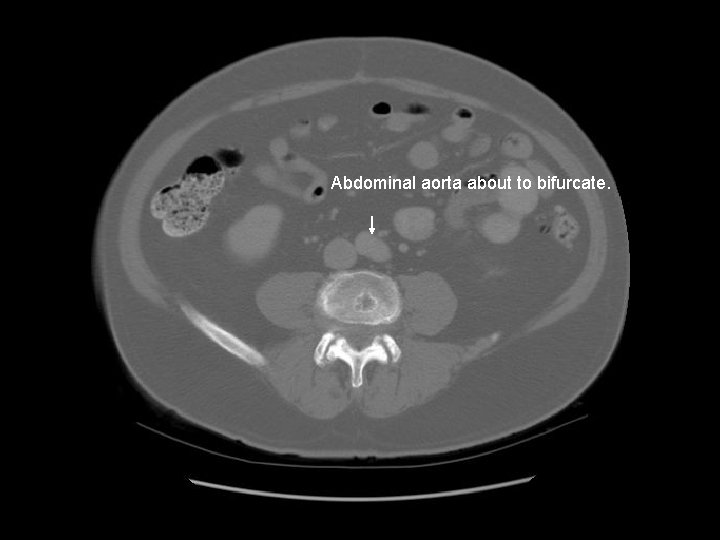 Abdominal aorta about to bifurcate. 