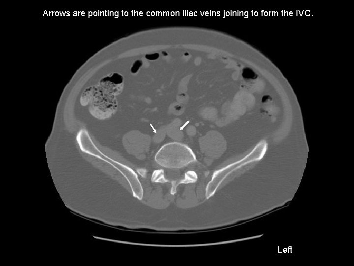 Arrows are pointing to the common iliac veins joining to form the IVC. Left