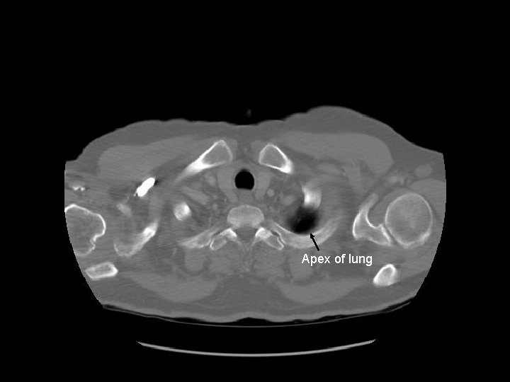 Apex of lung 