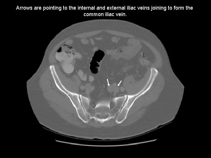 Arrows are pointing to the internal and external iliac veins joining to form the