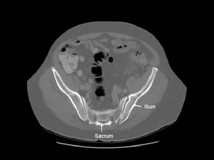 Ilium Sacrum 