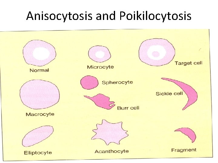 Anisocytosis and Poikilocytosis 