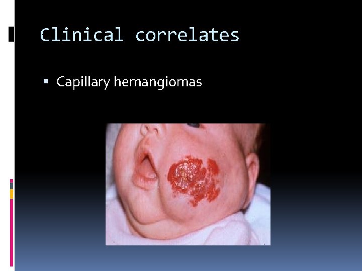 Clinical correlates Capillary hemangiomas 