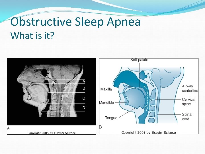 Obstructive Sleep Apnea What is it? 