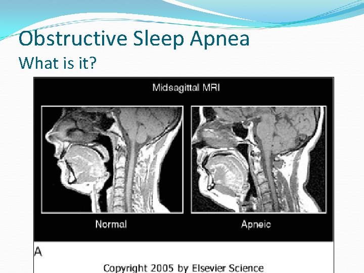 Obstructive Sleep Apnea What is it? 