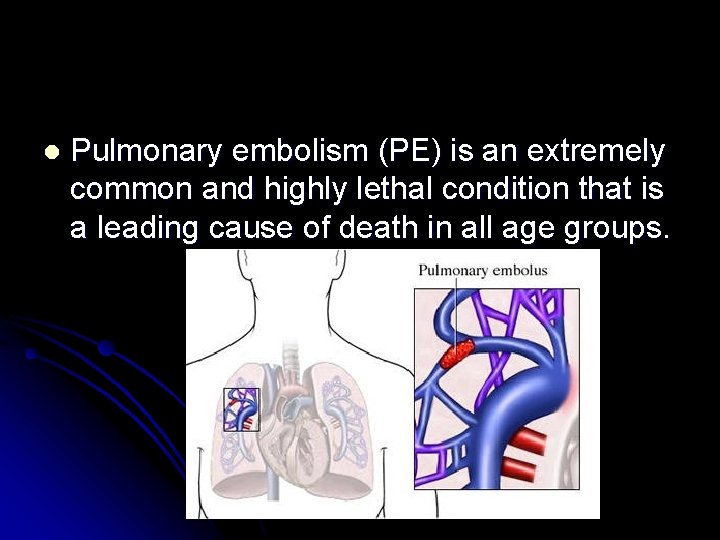 l Pulmonary embolism (PE) is an extremely common and highly lethal condition that is