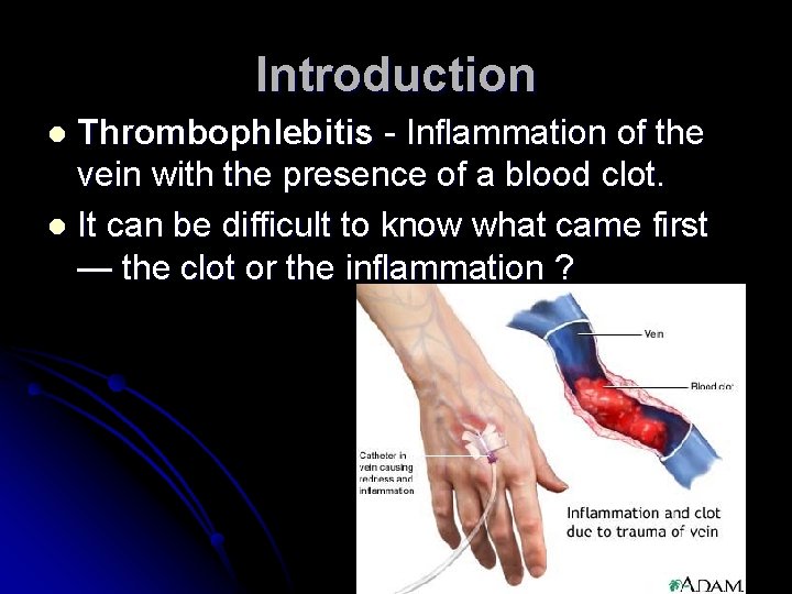 Introduction Thrombophlebitis - Inflammation of the vein with the presence of a blood clot.