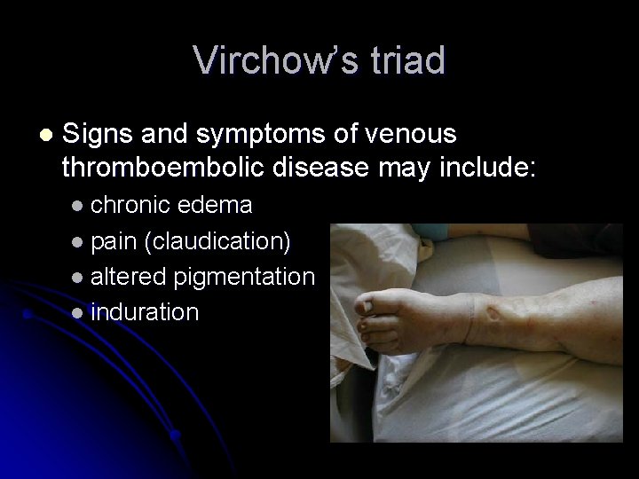 Virchow’s triad l Signs and symptoms of venous thromboembolic disease may include: l chronic