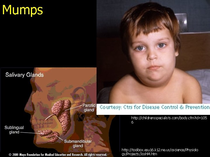 Mumps http: //childrensspecialists. com/body. cfm? id=105 6 http: //toolbox. esu 16. k 12. ne.