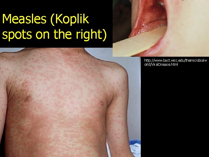 Measles (Koplik spots on the right) http: //www. bact. wisc. edu/themicrobialw orld/Viral. Disease. html