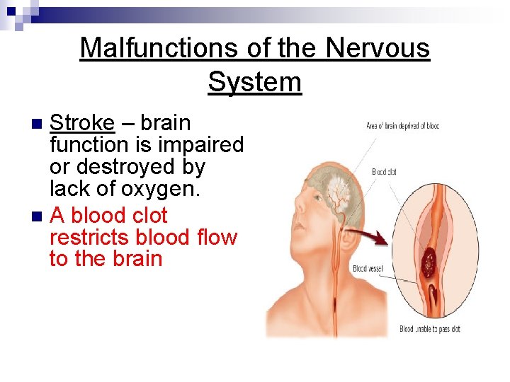 Malfunctions of the Nervous System Stroke – brain function is impaired or destroyed by