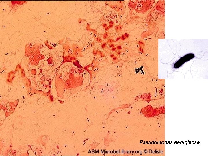 Pseudomonas aeruginosa 