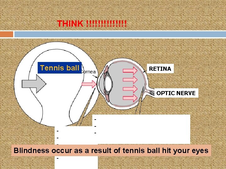 THINK !!!!!!! Tennis ball RETINA OPTIC NERVE Blindness occur - - as a result