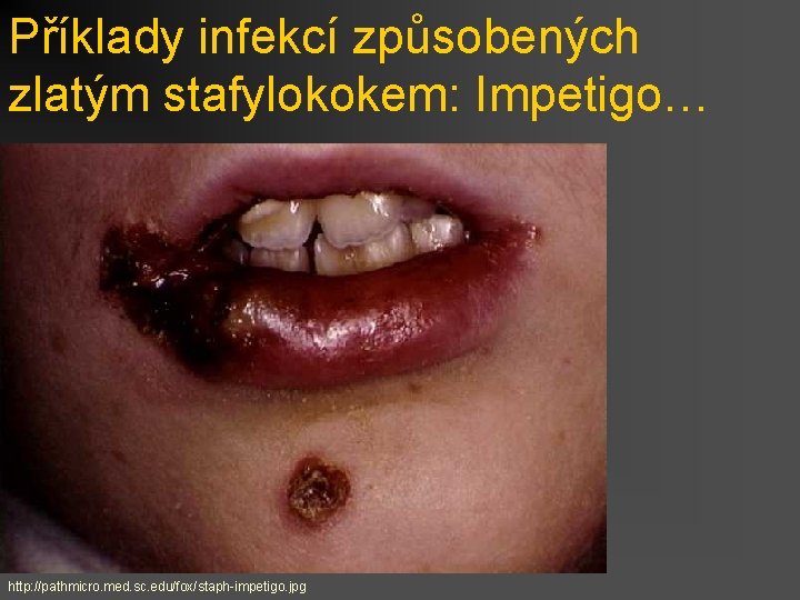 Příklady infekcí způsobených zlatým stafylokokem: Impetigo… http: //pathmicro. med. sc. edu/fox/staph-impetigo. jpg 