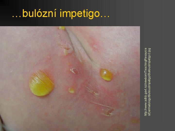 http: //www. adhb. govt. nz/newborn/Teaching. Resource s/Dermatology/Bullous. Impetigo 3. jpg …bulózní impetigo… 