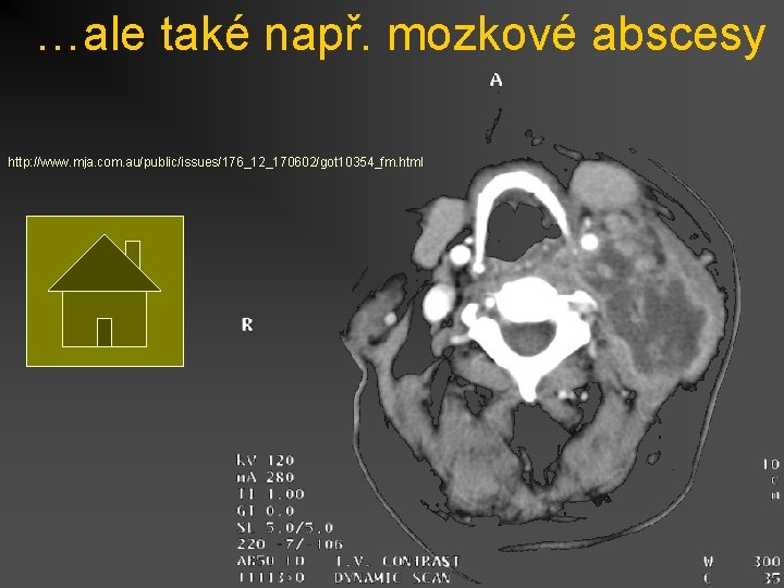 …ale také např. mozkové abscesy http: //www. mja. com. au/public/issues/176_12_170602/got 10354_fm. html 