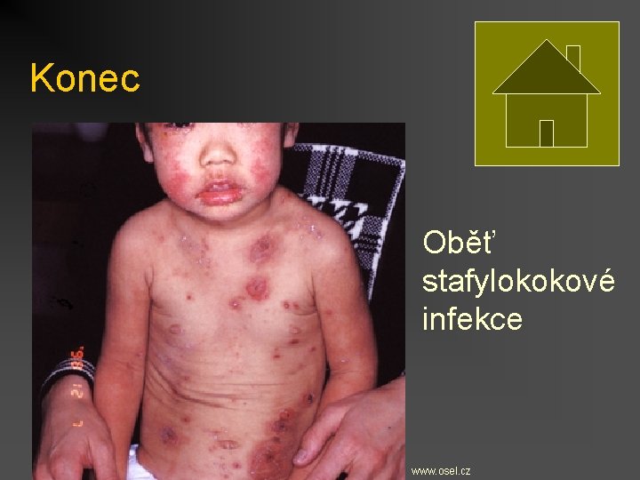 Konec Oběť stafylokokové infekce www. osel. cz 