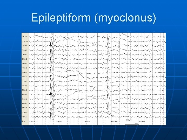 Epileptiform (myoclonus) 