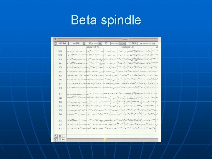 Beta spindle 