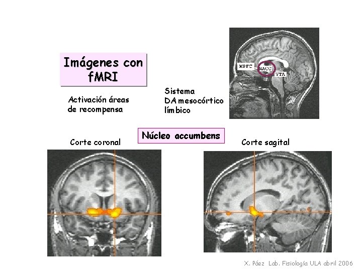 Imágenes con f. MRI Activación áreas de recompensa Corte coronal Sistema DA mesocórtico límbico