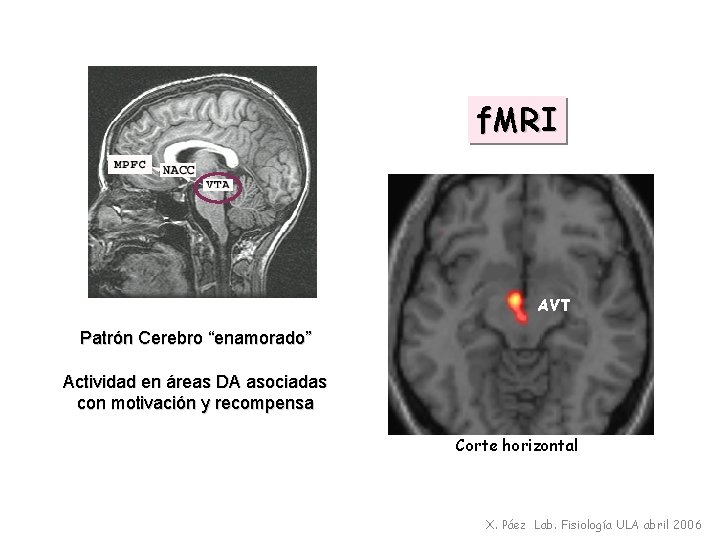 f. MRI AVT Patrón Cerebro “enamorado” Actividad en áreas DA asociadas con motivación y