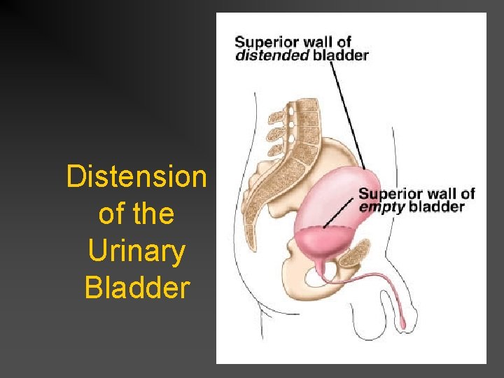 Distension of the Urinary Bladder 