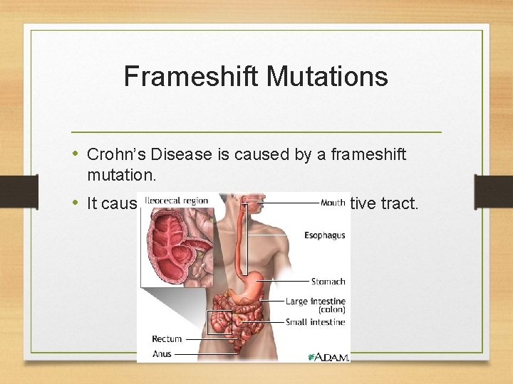 Frameshift Mutations • Crohn’s Disease is caused by a frameshift mutation. • It causes