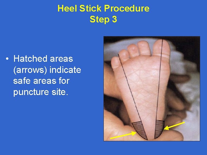Heel Stick Procedure Step 3 • Hatched areas (arrows) indicate safe areas for puncture