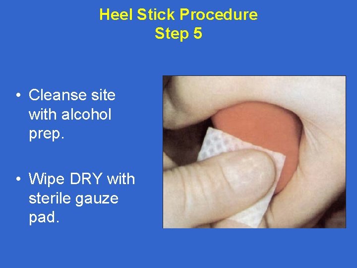 Heel Stick Procedure Step 5 • Cleanse site with alcohol prep. • Wipe DRY